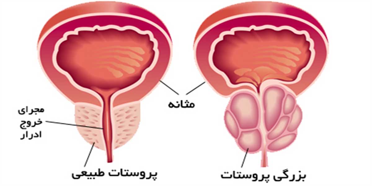 سرطان پروستات